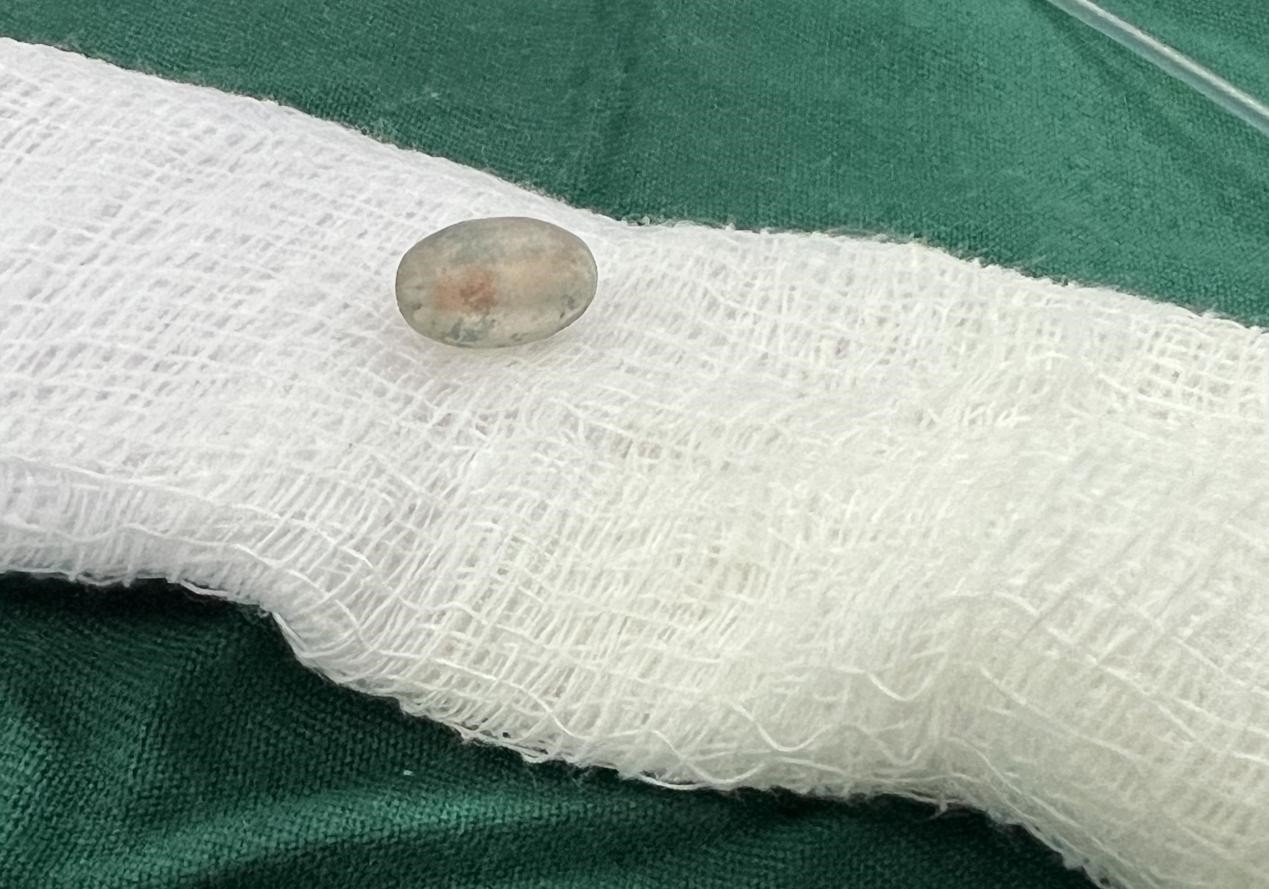 被取出的異物。中國援桑醫(yī)療隊(duì)供圖