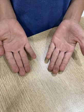 9歲小學(xué)生長(zhǎng)期拍煙卡，手部粗糙長(zhǎng)繭。受訪者供圖