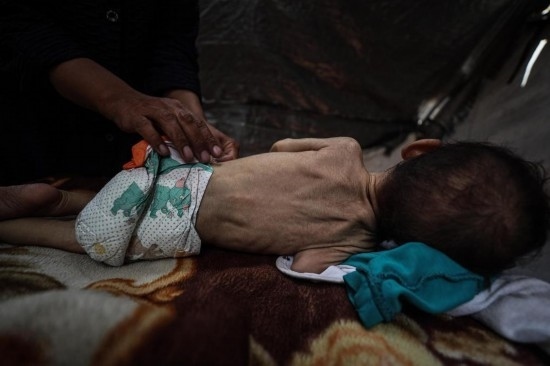 這是5月28日在加沙城西部一處臨時(shí)安置點(diǎn)拍攝的一名營(yíng)養(yǎng)不良的嬰兒。新華社發(fā)（馬哈茂德·扎基攝）